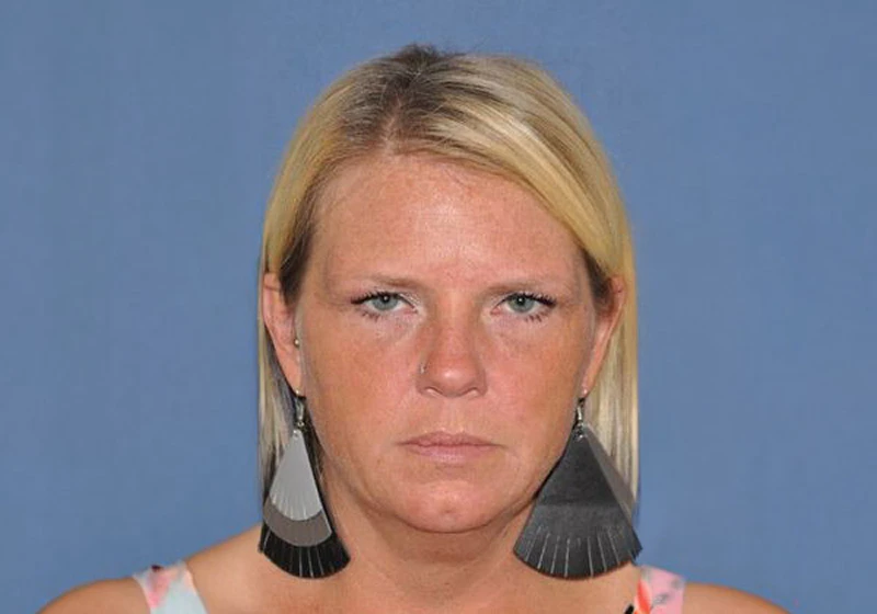 Patient before a facelift
