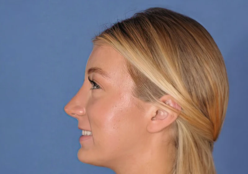 Patient after rhinoplasty