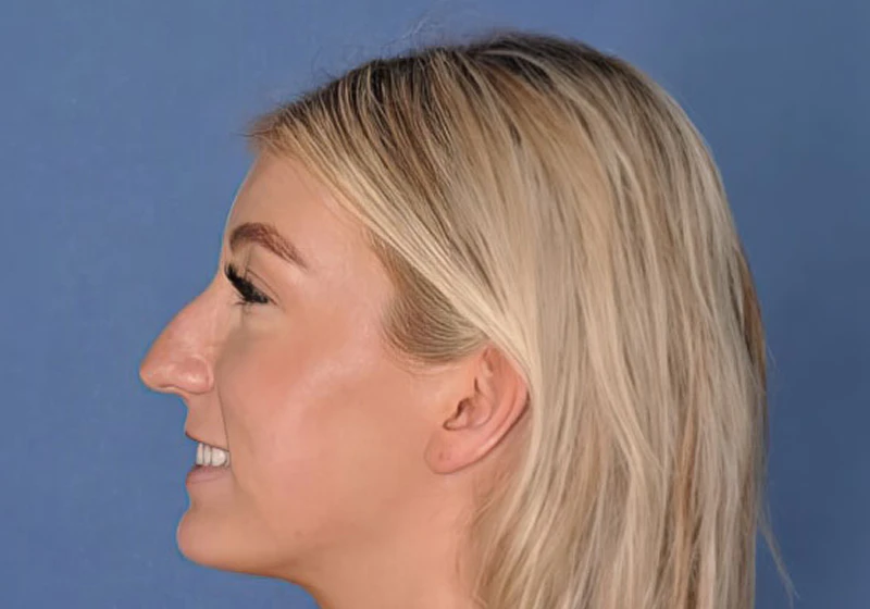 Patient before rhinoplasty