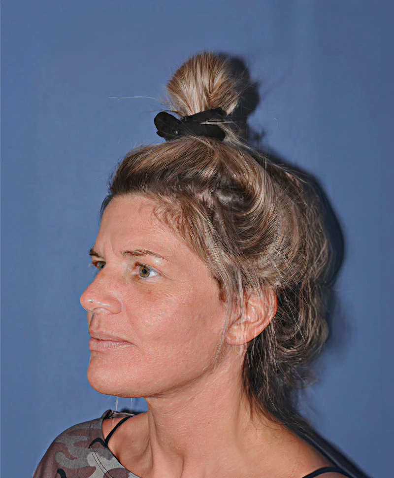 woman after facelift