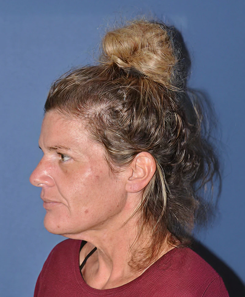 Woman before facelift