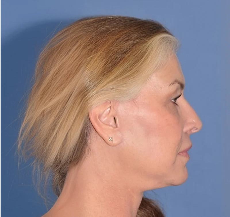 woman after a deep plane facelift