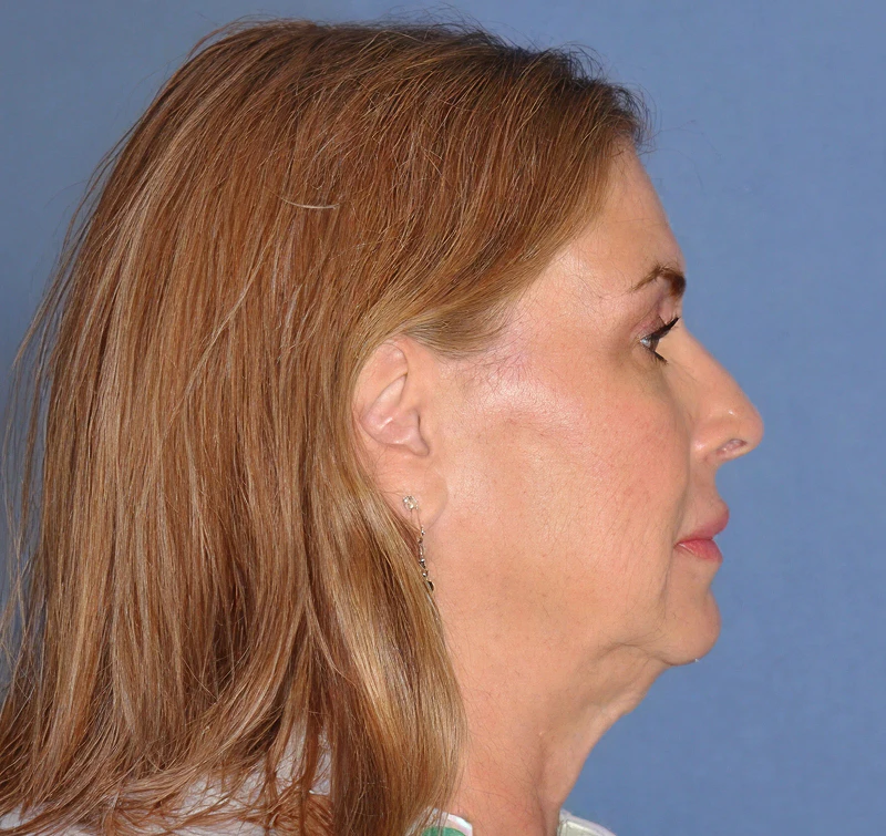 woman before a deep plane facelift
