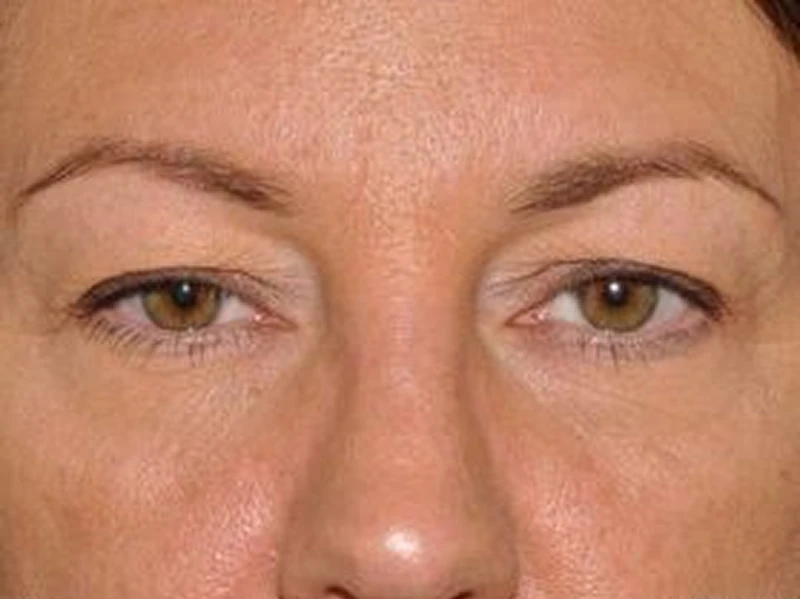 Buffalo patient before upper blepharoplasty