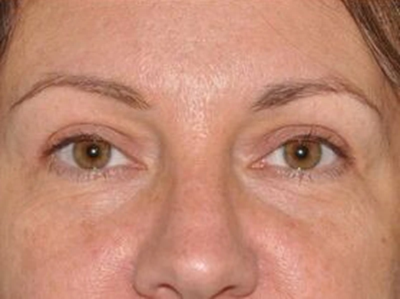 Buffalo patient after upper blepharoplasty