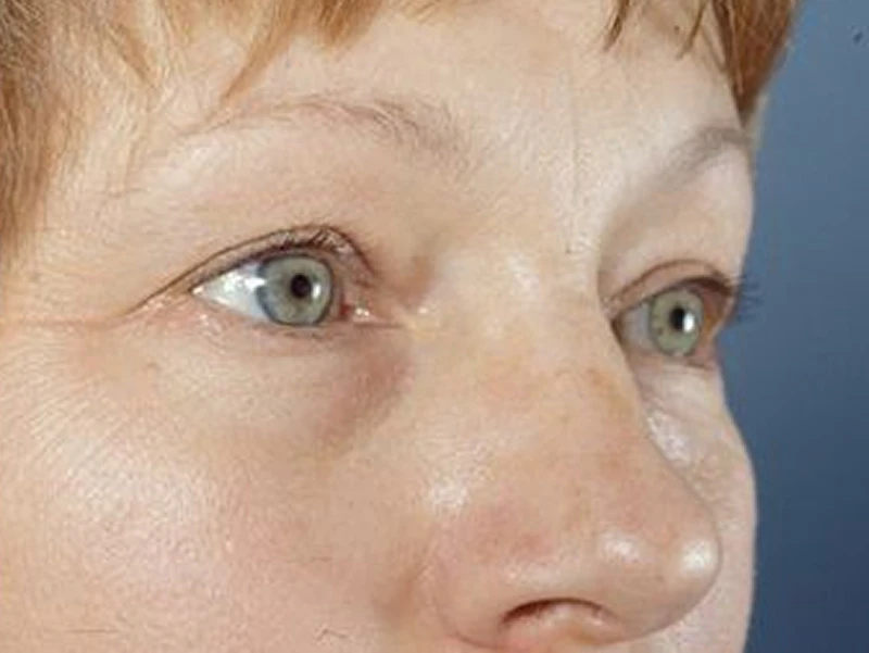 Buffalo patient before blepharoplasty