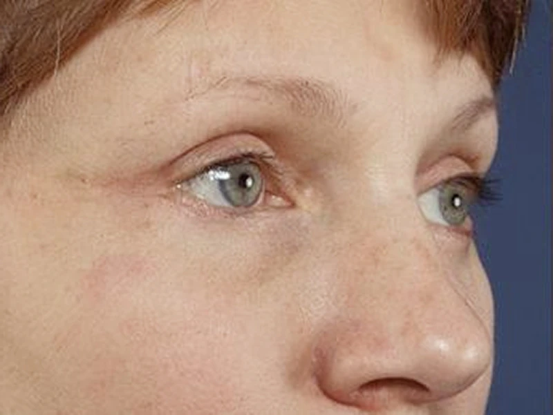 Buffalo patient after blepharoplasty