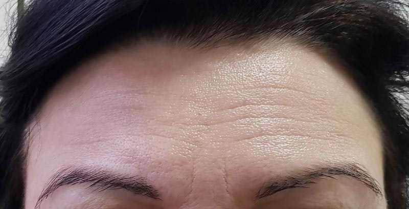 Forehead before injectables