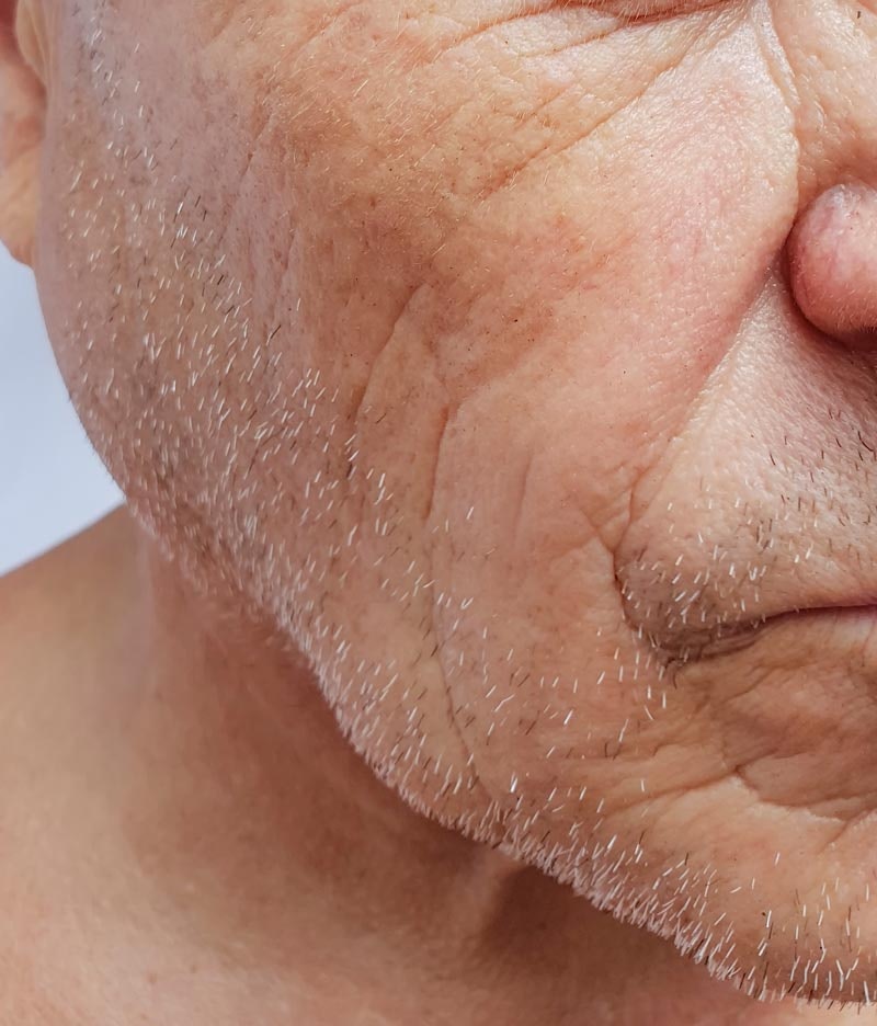 Man's jowl area before dermal fillers