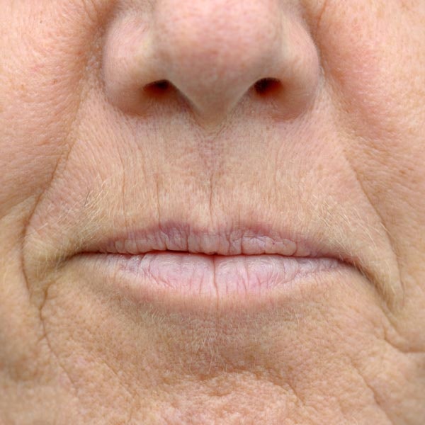 Closeup of lips and vertical lip lines