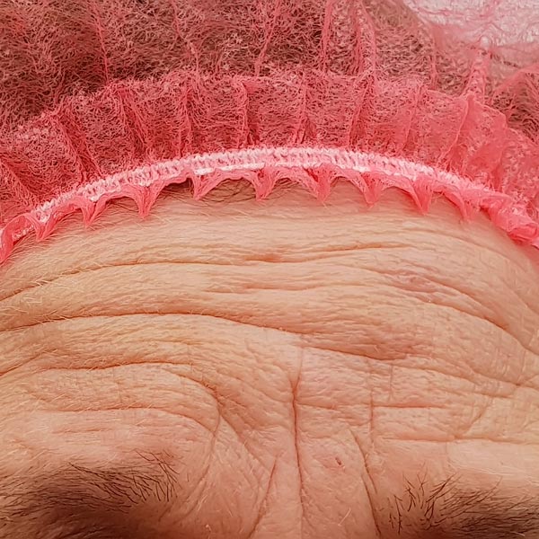 Wrinkles in forehead