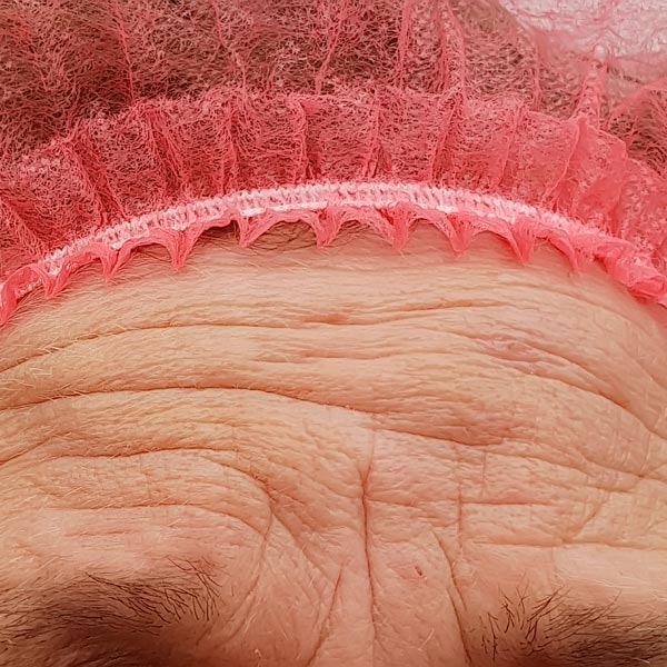 Wrinkles in forehead