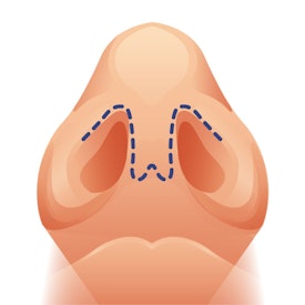 Open rhinoplasty incisions