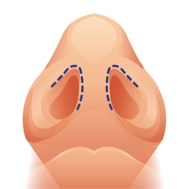 Closed rhinoplasty incisions