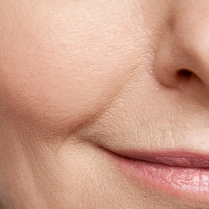 Nasolabial Folds