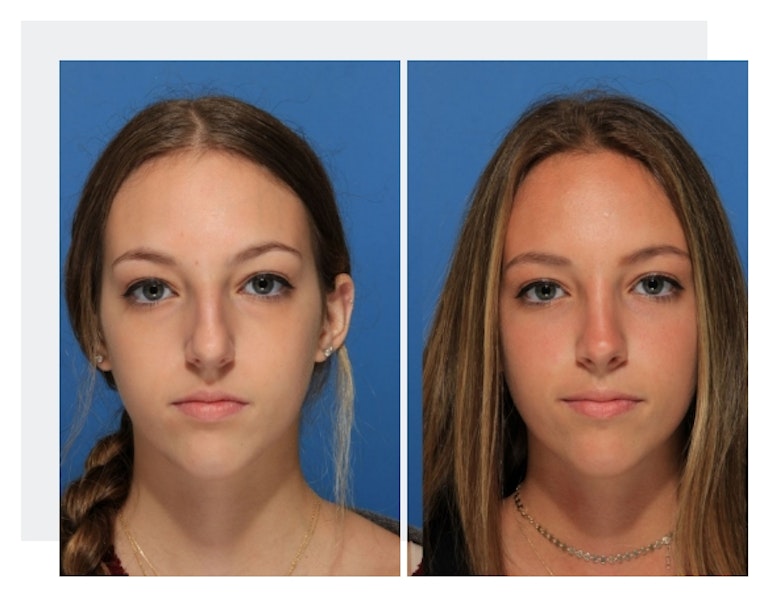 patient before rhinoplasty