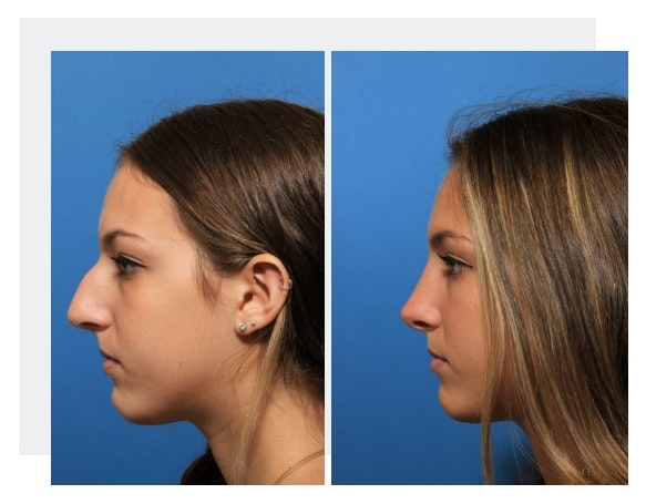 Rhinoplasty before and after on younger woman