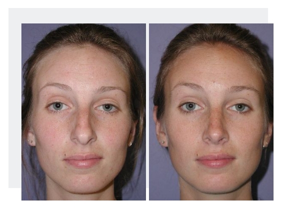 Case 11 before and after rhinoplasty procedure front view