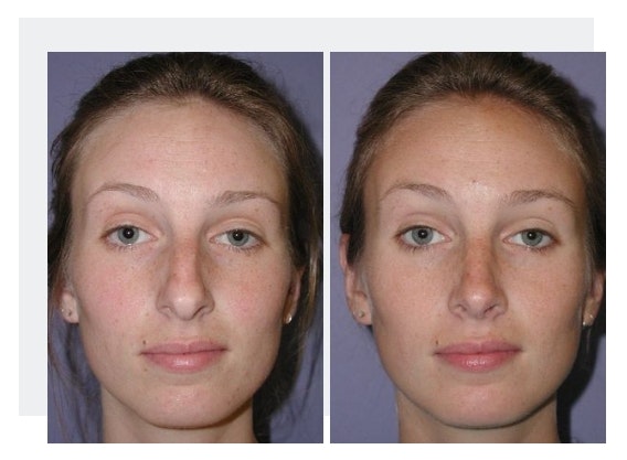 Case 11 before and after rhinoplasty procedure front view