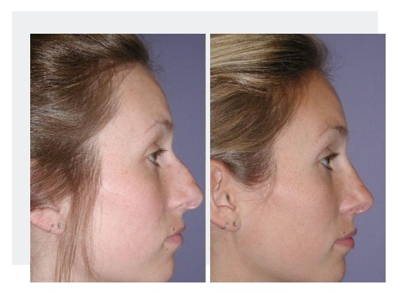 Case 11 before and after rhinoplasty procedure side view