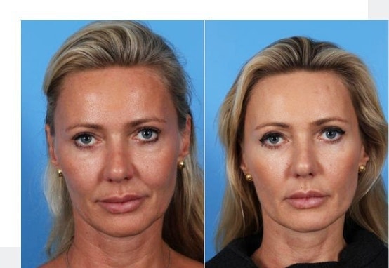 Rhinoplasty before and after on middle aged woman