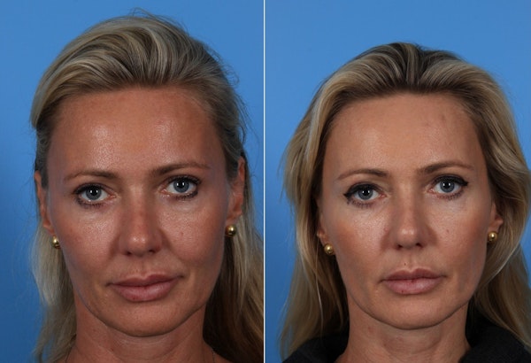 Dr. Jon Turk's patient before and after thread lift