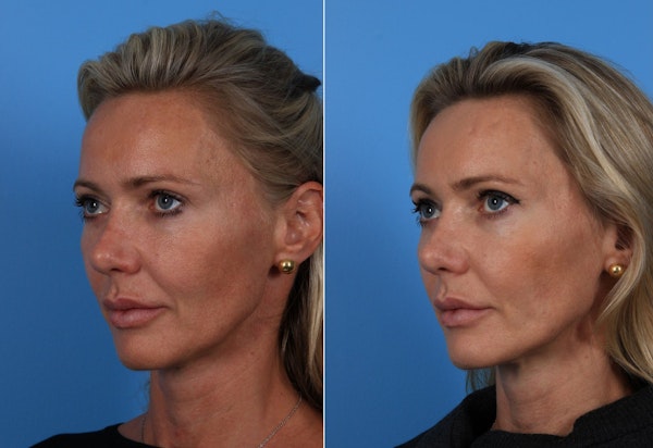 Dr. Jon Turk's patient before and after thread lift