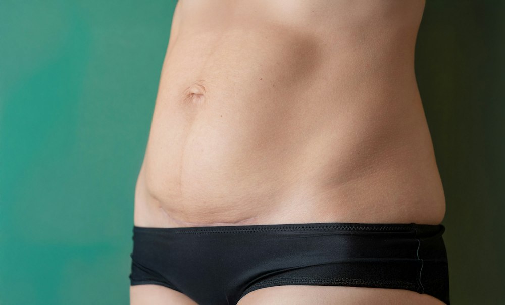 c-section scar