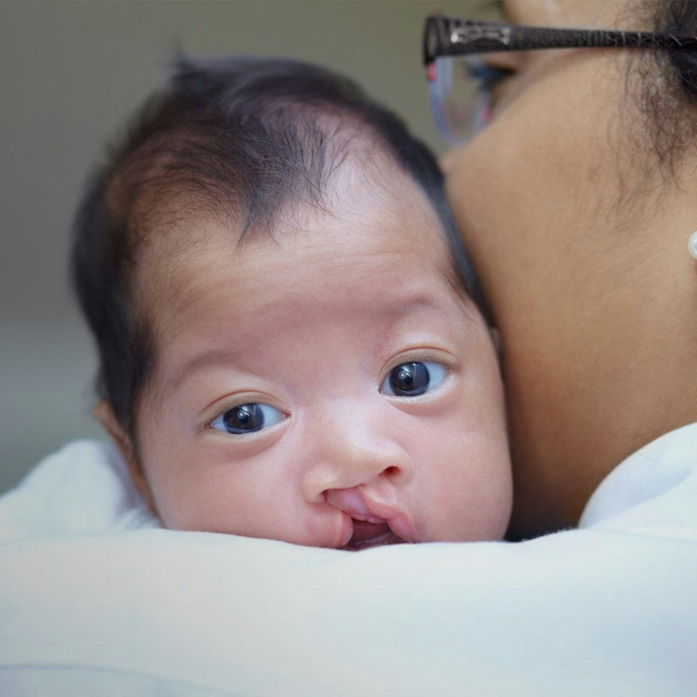 Baby with cleft lip looking over adult's shoulder