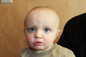 After Cleft Palate Treatment