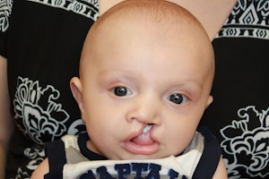 Before Cleft Palate Treatment