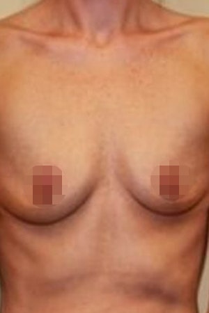 Before Breast Augmentation