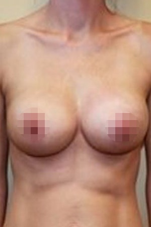 After Breast Augmentation