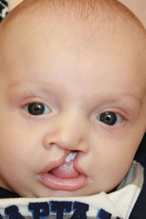 Before cleft palate surgery