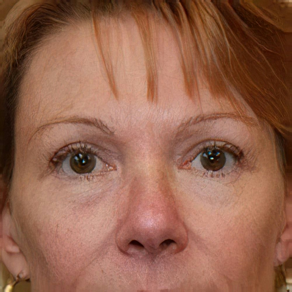 Dr. Stephen Hardy's patient after eyelid surgery