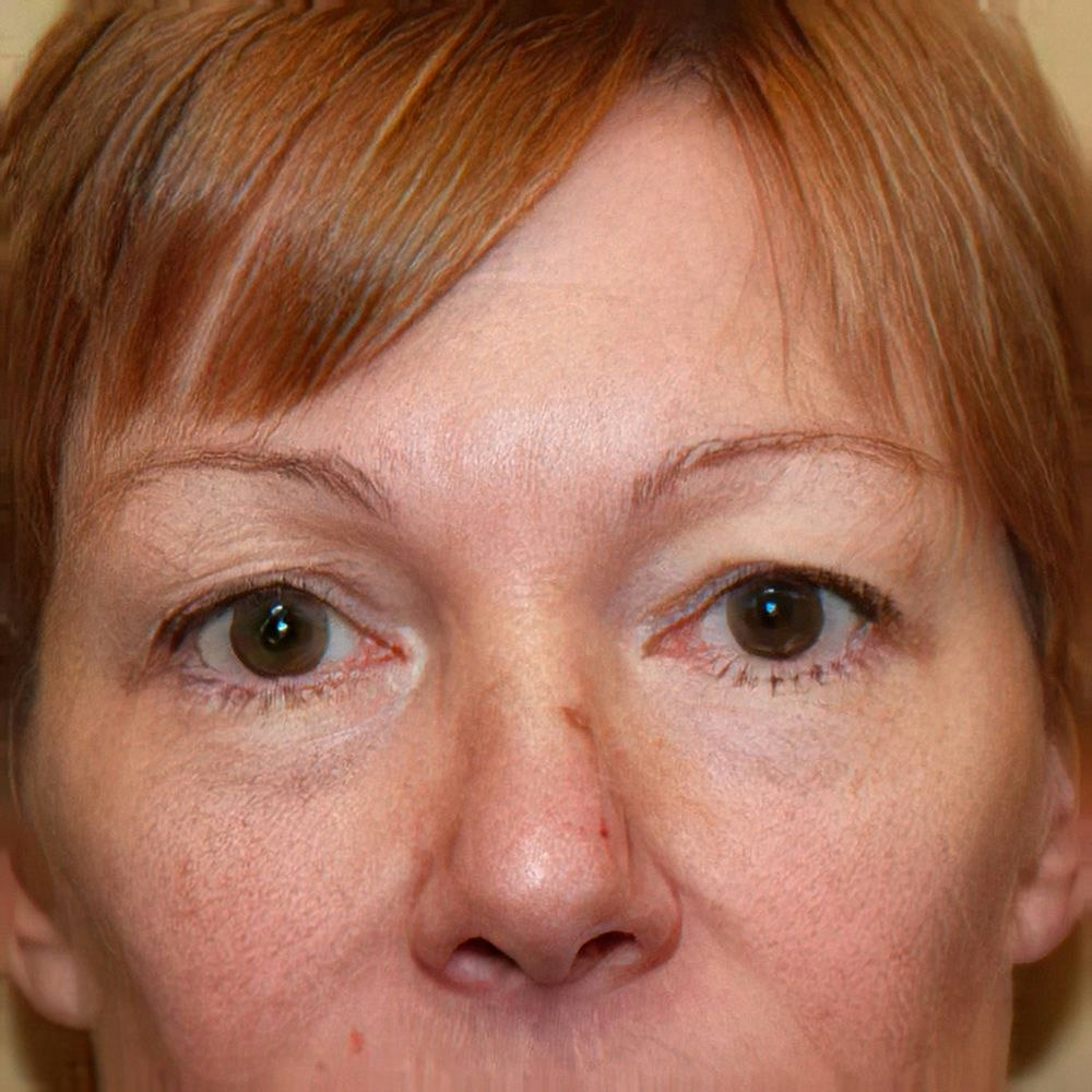Dr. Stephen Hardy's patient before eyelid surgery