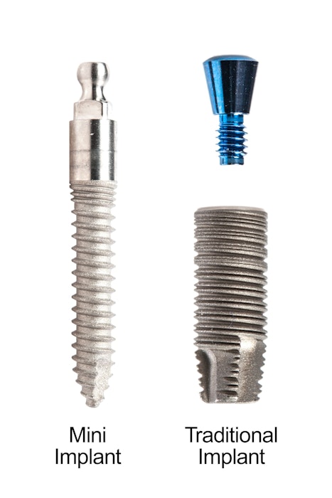 Mini vs traditional implants