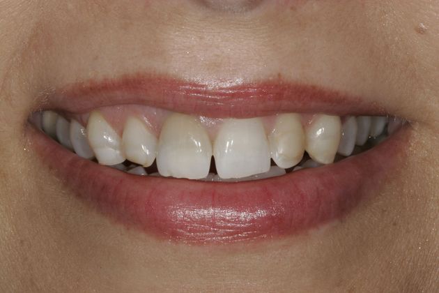 Dr. Nick Pournaras's patient with gapped and stained teeth