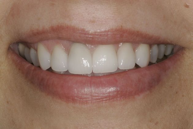 Dr. Nick Pournaras's patient with even, white teeth after dental veneers
