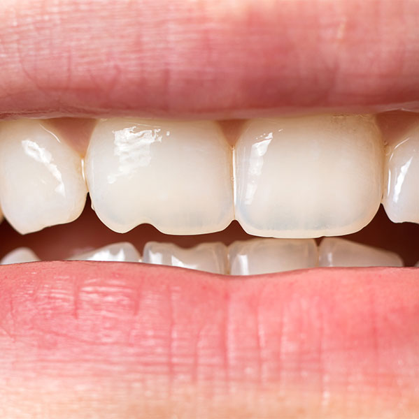close up of a chipped tooth
