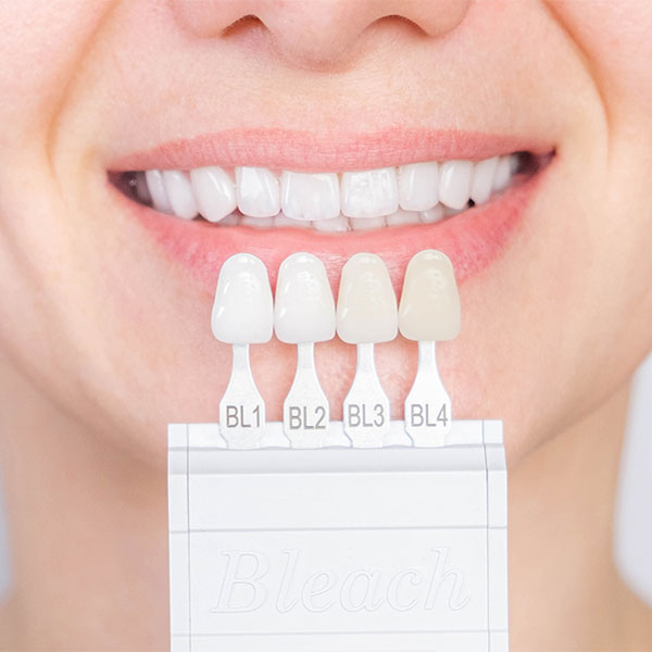 shade matching for teeth whitening