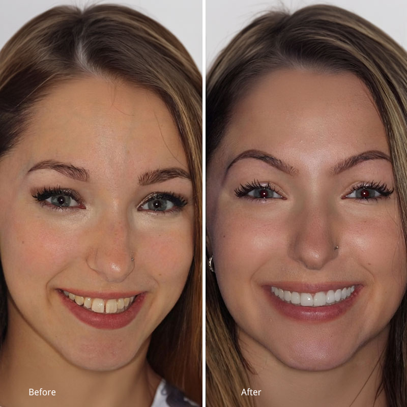 Before and after cosmetic dentistry