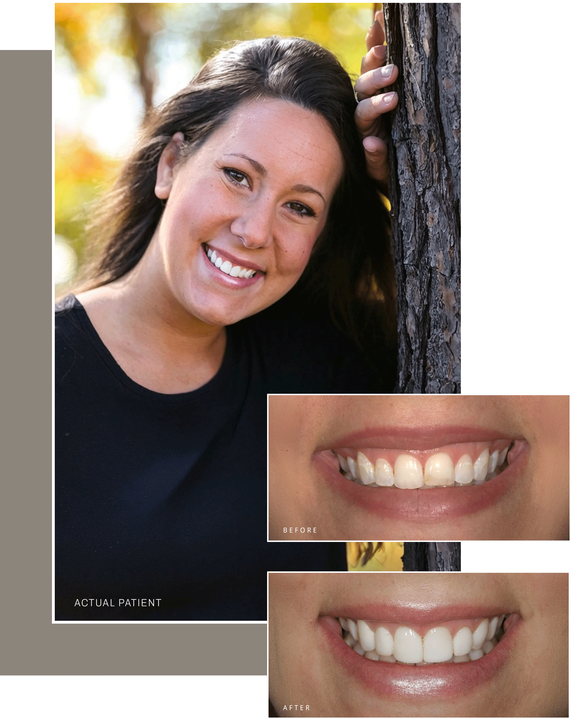 Collage of patient portrait with before and after dental crown results