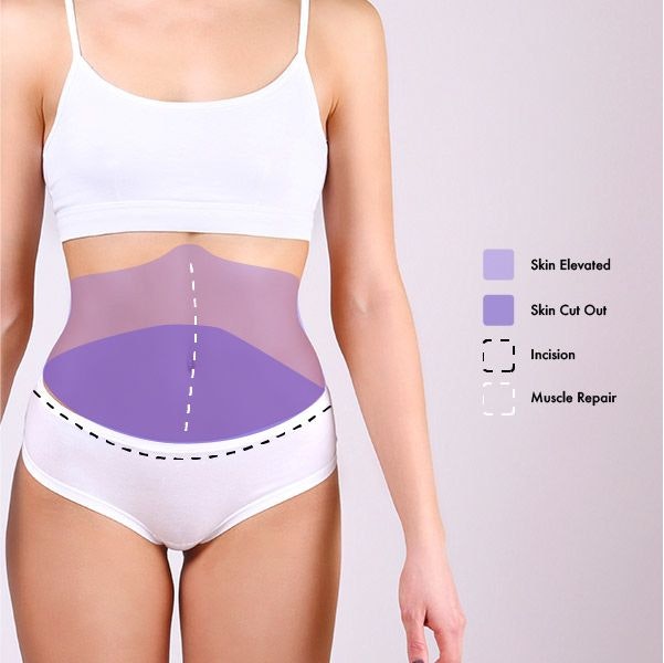 Modified or Extended Tummy Tuck incision diagram of when the skin is elevated, cut out, and its muscles are repaired