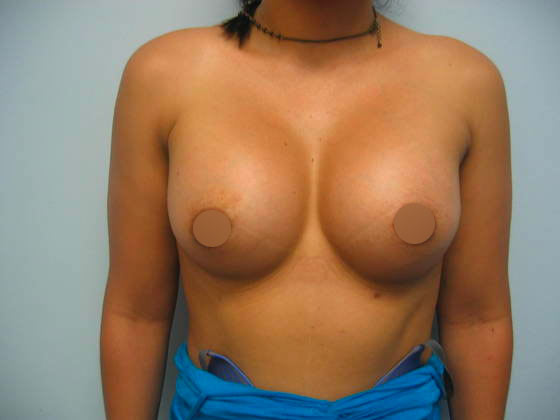Woman after breast augmentation