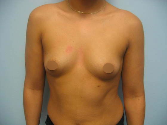 Woman before breast augmentation