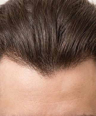 Hair line