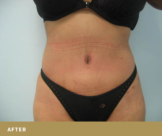 Patient's abdomen after abdominoplasty with Dr. Rassael showing a flatter, contoured midsection