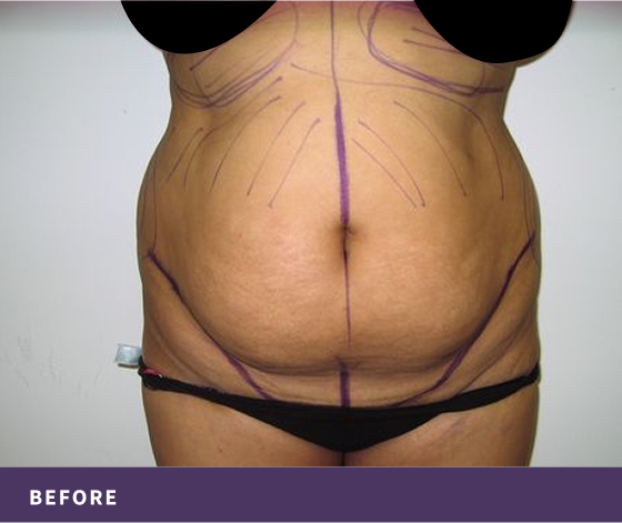Patient's abdomen with pre-surgical markings before abdominoplasty with Dr. Rassael