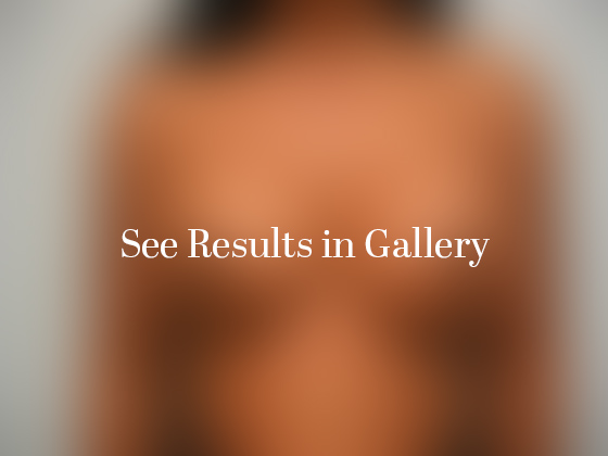 After breast augmentation